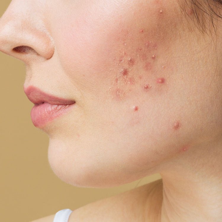 Skincare para  piel acnéica - Cosmética Vicorva